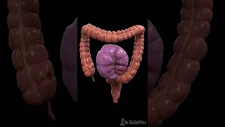 Understanding Colon Volvulus A Twist in the Digestive Tale [upl. by Towill]