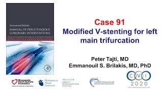 Case 91 PCI Manual  Left main trifurcation [upl. by Zebadiah646]