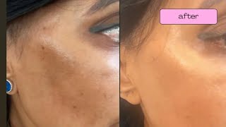 Before and After results Available from wwwskincarebydrvcom [upl. by Loris]