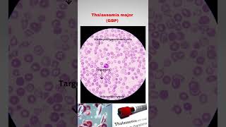 GBP of Thalassemia major draditikumar pathologyacademy mbbs neet neetpg thalassemia usmle [upl. by Genvieve]