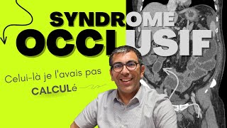 Iléus Biliaire  une cause rare mais classique de syndrome occlusif découverte au SCANNER [upl. by Derna]