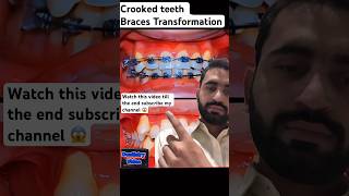 The Truth About Crooked Teeth amp Braces [upl. by Udelle]