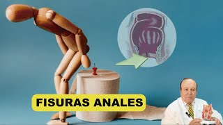 Las Fisuras Anales  Todo lo que querías saber [upl. by Kcirdnek]