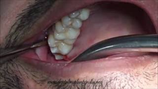 Forceps extraction of decayedbuccoverted upper 3rd molar [upl. by Otanod]