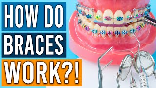 How Do Braces Work [upl. by Anerol412]