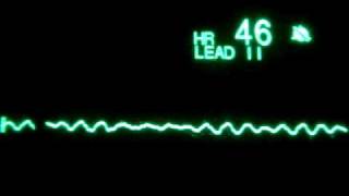 Fine Ventricular Fibrillation [upl. by Kwapong]