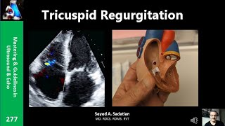 Tricuspid Regurgitation [upl. by Nelyak]