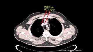 Major Thoracic Vessels  Venous [upl. by Narej519]