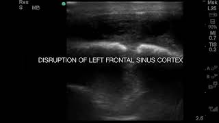 Left Frontal Bone Osteomyelitis Potts Puffy Tumor [upl. by Eddy]