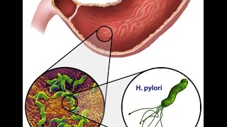 Helicobacter Pylori [upl. by Vasti]