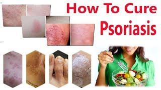 How To Treat Psoriasis At Home  Home Remedies To Cure Psoriasis Naturally [upl. by Anoid625]