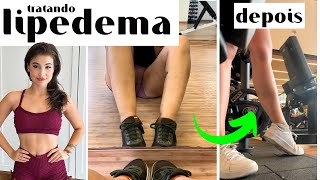 COMO IDENTIFICAR E TRATAR LIPEDEMA [upl. by Okimik]