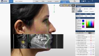 Software de Cefalometria CEFAX [upl. by Frankie]