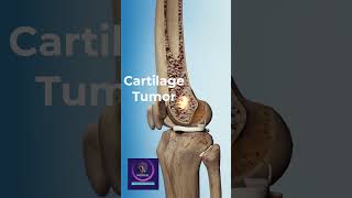 Cartilage Tumor 3D Animation shorts [upl. by Gaul]