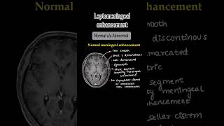 Leptomeningeal enhancement Full video on our channelXrayusg mri brain neuroimaging neetpg [upl. by Iow5]