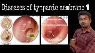 Diseases of Tympanic membrane [upl. by Cicily]