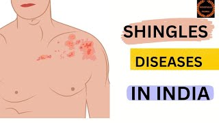 SHINGLES  शिंगल्स हरपीज़ ज़ोस्टर रोग लक्षण कारण और उपचारquot [upl. by Enegue786]