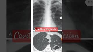 CT  X ray of cavitary lung lesion [upl. by Sibley]