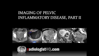 Imaging of Pelvic Inflammatory Disease Part II [upl. by Elockin686]