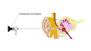 Ear Drum Ear Perforation Repair [upl. by Einaej59]