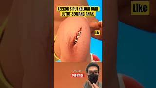 Seekor Siput Keluar dari Lutut Anak Kisah yang sangat langka terjadi [upl. by Maya887]