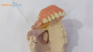 Definitive obturator maxillofacial prosthesis [upl. by Lowell]