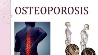 Osteoporosis Causes Symptoms Treatment [upl. by Ria89]