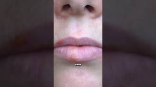 How are cold sores transmitted👩🏻‍⚕️ herpes health interestingfacts medicine [upl. by Asilrak]