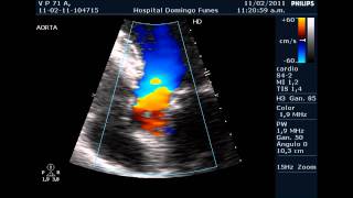 Insuficiencia Valvular Aortica Aorta Bicuspidewmv [upl. by Llednav]