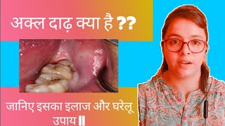 अक्ल दाढ़ क्या है  Wisdom tooth इलाज और घरेलू उपाय [upl. by Eibrad306]