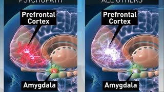 Psychopaths Can Their Brains Be Fixed [upl. by Apurk911]