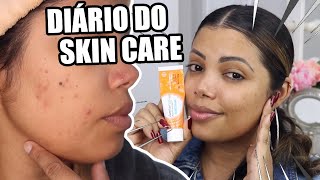 MINHA EXPERIÊNCIA COM O AZELAN GEL  Cheia de Truques [upl. by Gaelan799]