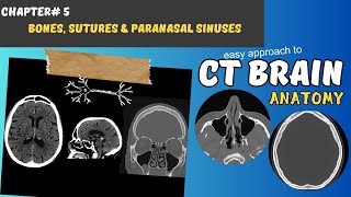 CT BRAIN Chapter 5 Skull bones Sutures amp the Paranasal sinuses [upl. by Adnilrem]