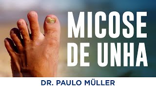 Micose de Unha  Dr Paulo Müller Dermatologista [upl. by Politi143]