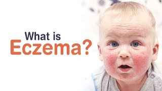 What is Eczema  ECZEMA IN BABIES  CHILDCARE  SKIN CARE [upl. by Schlosser387]