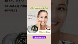 Wellution Cystic Acne Treatment face Cream howtolightendarkspots antiaging [upl. by Enuj]