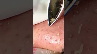 Skincare  Blackheads Removal 275 tweezers skincare blackheads blackheads [upl. by Coyle640]