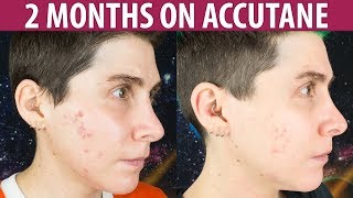 Accutane for Persistent Mild Acne — 2 Month Update [upl. by Lehet]