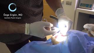 Upper Lip Lift Surgery  Ozge Ergun MD  Plastic Surgery  Istanbul [upl. by Relluf307]