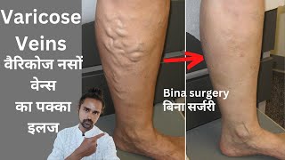 पाँवो की नस फूल जाने Varicose Veins का इलाज Varicose Veins treatment acupressure marma yoga [upl. by Fowkes]