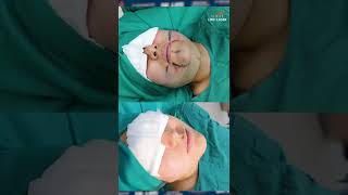 Increíble resultado de una LIPOPAPADA  BICHECTOMÍA Antes y después  Lipoylaser Perú [upl. by Nell]