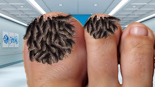 ASMR Toe Treatment Remove Ticks amp Worm Infection  ASMR 2d Severely loosing Toe treatment [upl. by Azile317]