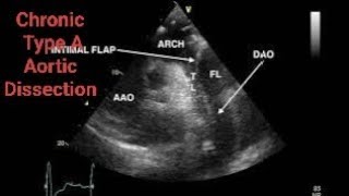 Chronic Type A Aortic Dissection CTAD Echocardiography post AVR [upl. by Todd]