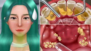 ASMR Old Tonsil Stone Removal Animation‼️Makeup The cause of Bad Breath [upl. by Foy]