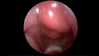 Nasopharyngeal Carcinoma NPC Endoscopic View of Nasopharynx Versus Normal [upl. by Yurt855]