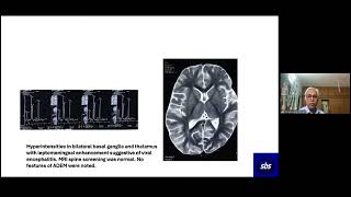 1 year 3 months toddler with encephalopathy amp DogbiteAn interesting case [upl. by Ecidnac]