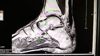 Achilles tendon rupture as seen on an MRI [upl. by Asille]