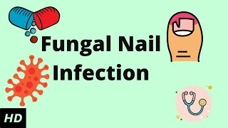 Fungal Nail Infection Causes Signs and Symptoms Diagnosis and Treatment [upl. by Aehtla158]