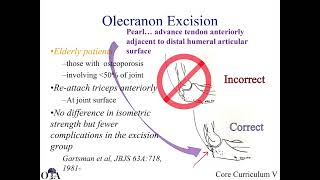 Olecranon fractures  1 of 2 [upl. by Ikiv200]