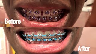 FULL BRACES JOURNEY 1 amp 12 YEARS GAPS SMALL OVERBITE CHAINS AND OVERALL EXPERIENCE [upl. by Spenser]